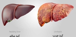 راه های مقابله با کبد چرب 